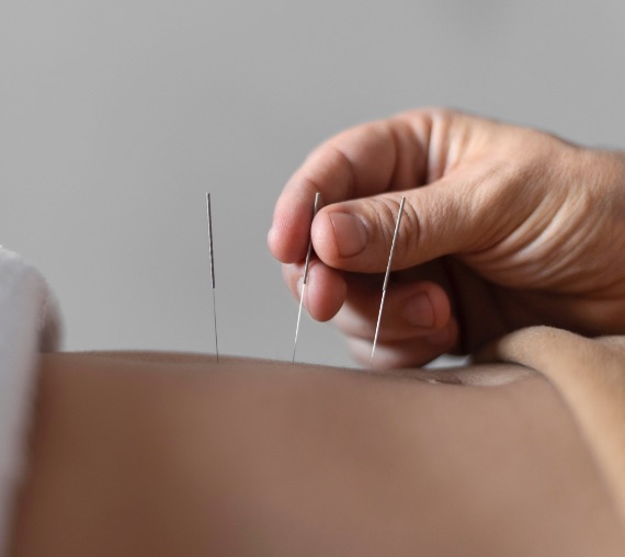 acupunctura